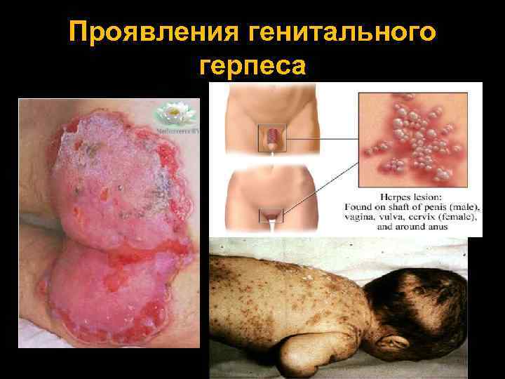 Проявления генитального герпеса 