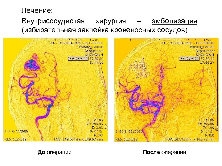 Лечение: Внутрисосудистая хирургия – эмболизация (избирательная заклейка кровеносных сосудов) До операции После операции 