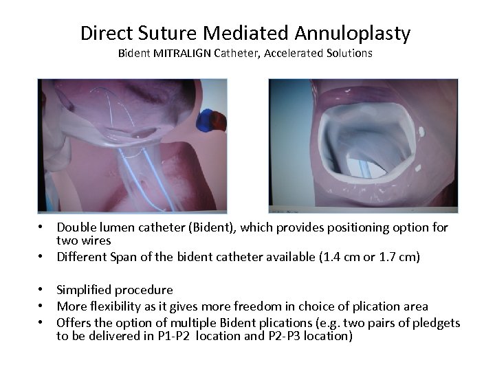 Direct Suture Mediated Annuloplasty Bident MITRALIGN Catheter, Accelerated Solutions • Double lumen catheter (Bident),
