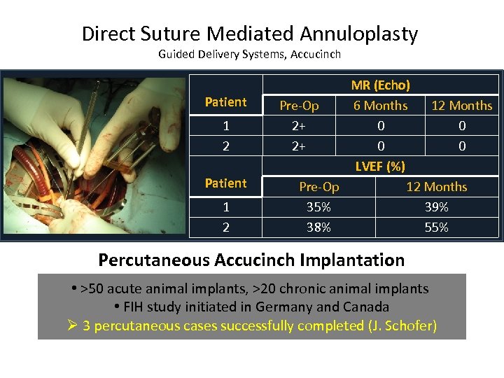 Direct Suture Mediated Annuloplasty Guided Delivery Systems, Accucinch Patient 1 2 MR (Echo) Pre-Op