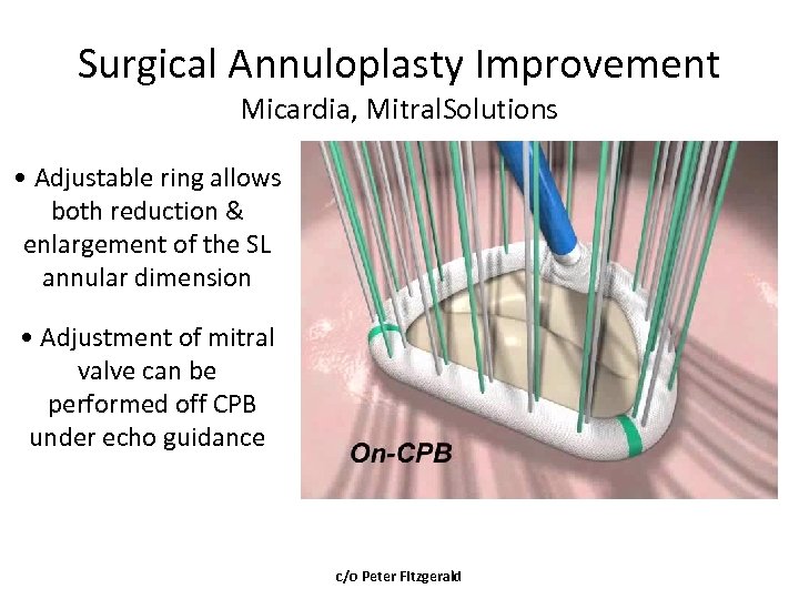 Surgical Annuloplasty Improvement Micardia, Mitral. Solutions • Adjustable ring allows both reduction & enlargement