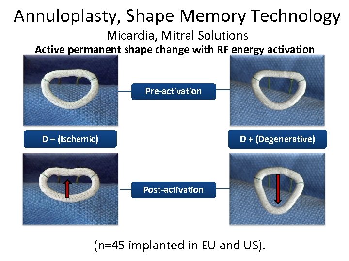 Annuloplasty, Shape Memory Technology Micardia, Mitral Solutions Active permanent shape change with RF energy