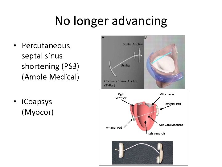 No longer advancing • Percutaneous septal sinus shortening (PS 3) (Ample Medical) • i.