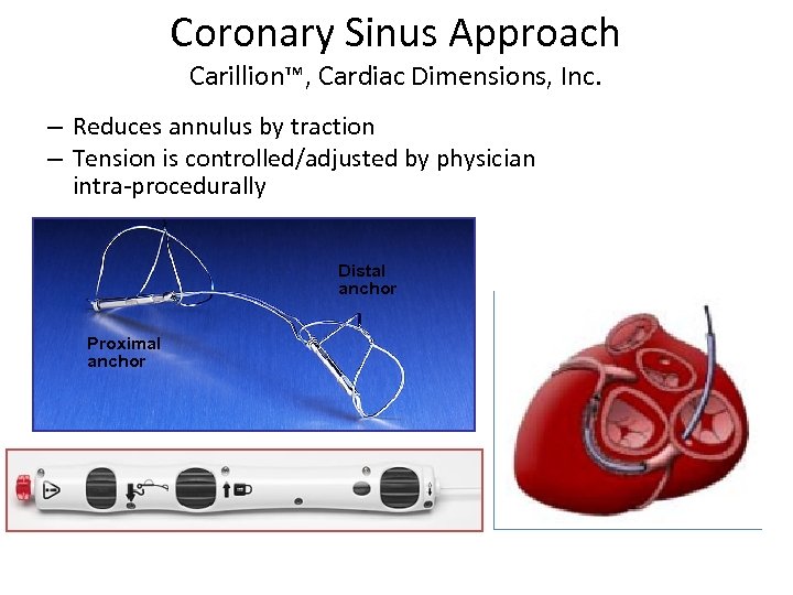 Coronary Sinus Approach Carillion™, Cardiac Dimensions, Inc. – Reduces annulus by traction – Tension