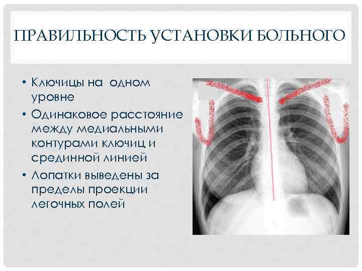 Поля легких