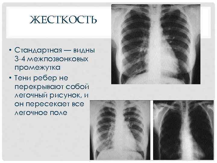 ЖЕСТКОСТЬ • Стандартная — видны 3 -4 межпозвонковых промежутка • Тени ребер не перекрывают