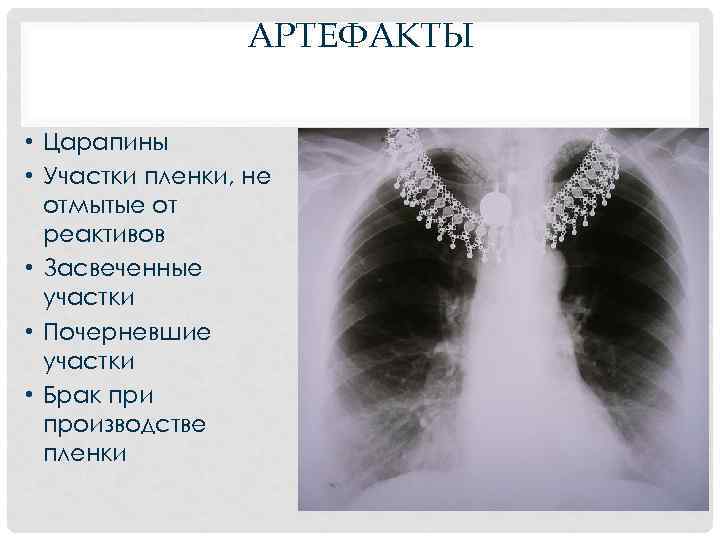 АРТЕФАКТЫ • Царапины • Участки пленки, не отмытые от реактивов • Засвеченные участки •