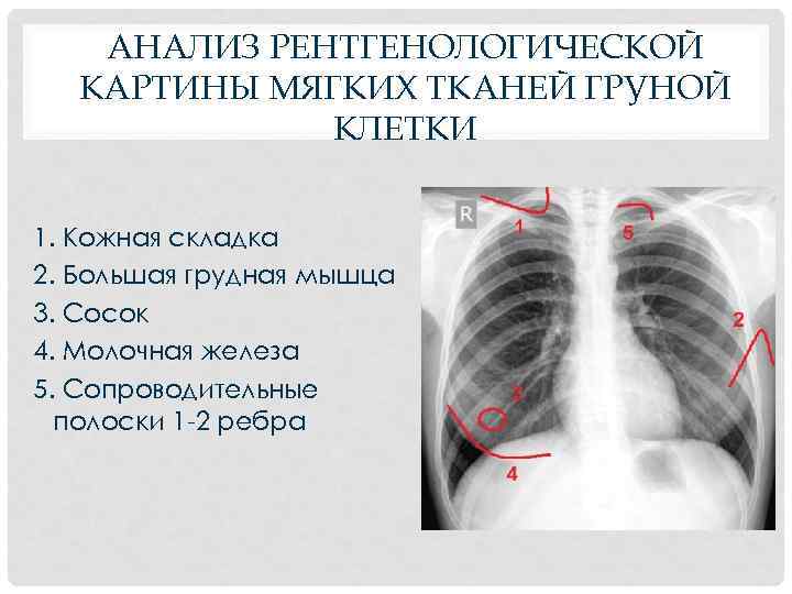 АНАЛИЗ РЕНТГЕНОЛОГИЧЕСКОЙ КАРТИНЫ МЯГКИХ ТКАНЕЙ ГРУНОЙ КЛЕТКИ 1. Кожная складка 2. Большая грудная мышца