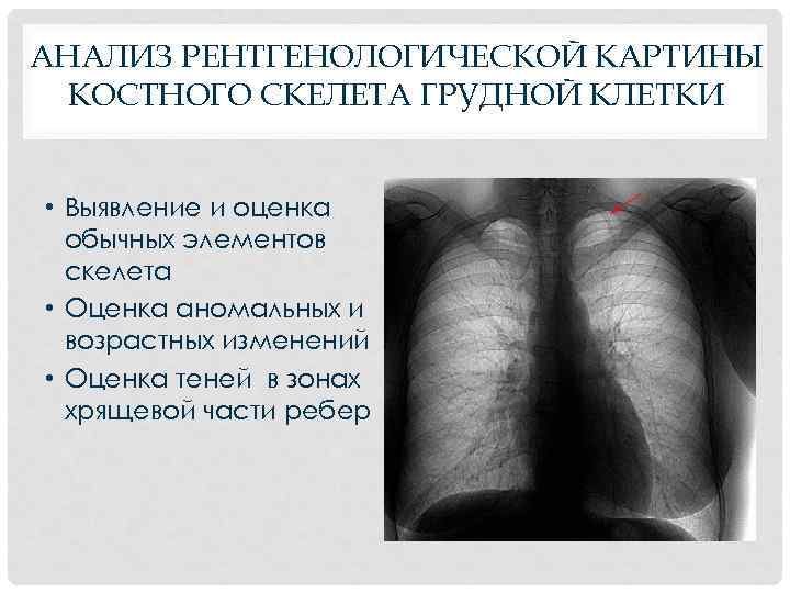 АНАЛИЗ РЕНТГЕНОЛОГИЧЕСКОЙ КАРТИНЫ КОСТНОГО СКЕЛЕТА ГРУДНОЙ КЛЕТКИ • Выявление и оценка обычных элементов скелета