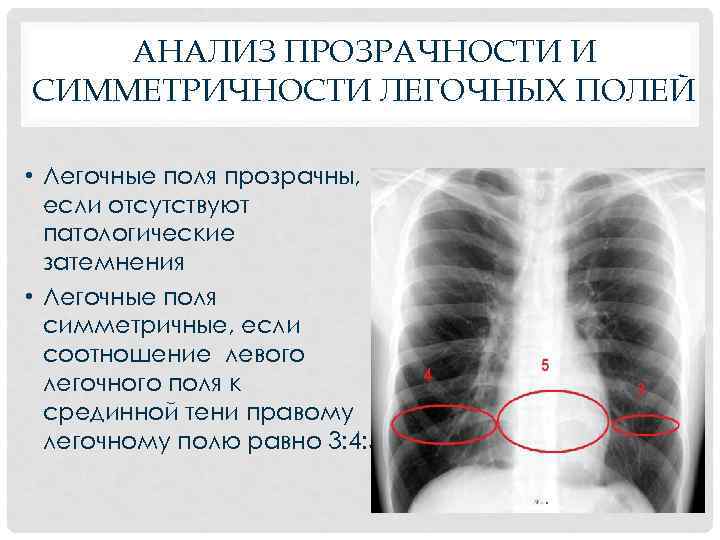 АНАЛИЗ ПРОЗРАЧНОСТИ И СИММЕТРИЧНОСТИ ЛЕГОЧНЫХ ПОЛЕЙ • Легочные поля прозрачны, если отсутствуют патологические затемнения