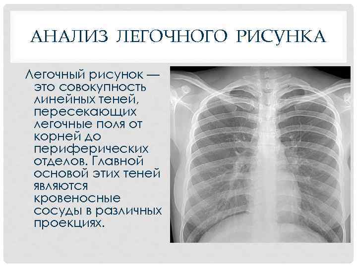 АНАЛИЗ ЛЕГОЧНОГО РИСУНКА Легочный рисунок — это совокупность линейных теней, пересекающих легочные поля от