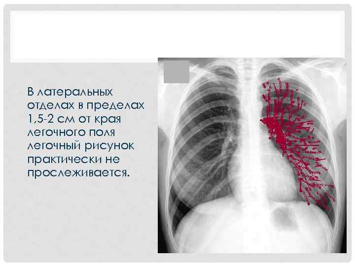  • В латеральных отделах в пределах 1, 5 -2 см от края легочного