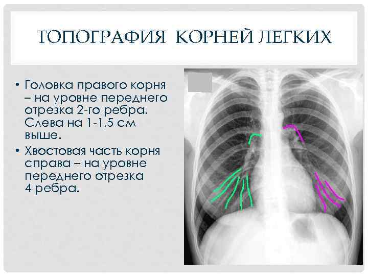 ТОПОГРАФИЯ КОРНЕЙ ЛЕГКИХ • Головка правого корня – на уровне переднего отрезка 2 -го