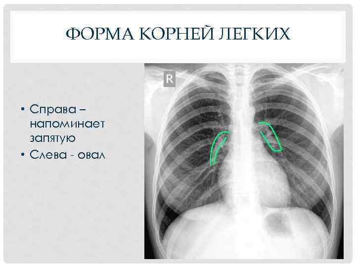 ФОРМА КОРНЕЙ ЛЕГКИХ • Справа – напоминает запятую • Слева - овал 