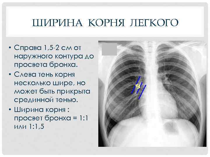 ШИРИНА КОРНЯ ЛЕГКОГО • Справа 1, 5 -2 см от наружного контура до просвета