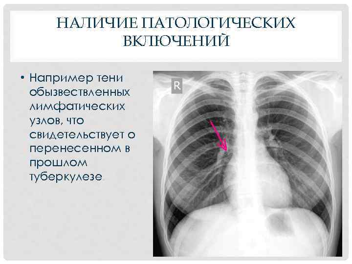 НАЛИЧИЕ ПАТОЛОГИЧЕСКИХ ВКЛЮЧЕНИЙ • Например тени обызвествленных лимфатических узлов, что свидетельствует о перенесенном в