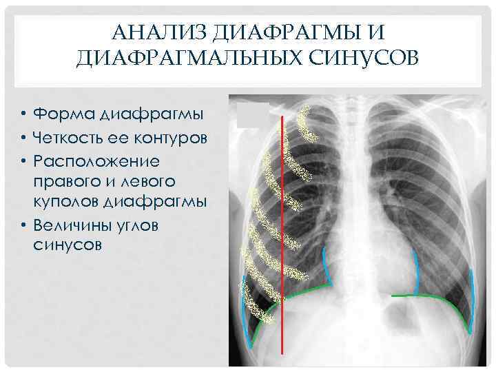 АНАЛИЗ ДИАФРАГМЫ И ДИАФРАГМАЛЬНЫХ СИНУСОВ • Форма диафрагмы • Четкость ее контуров • Расположение