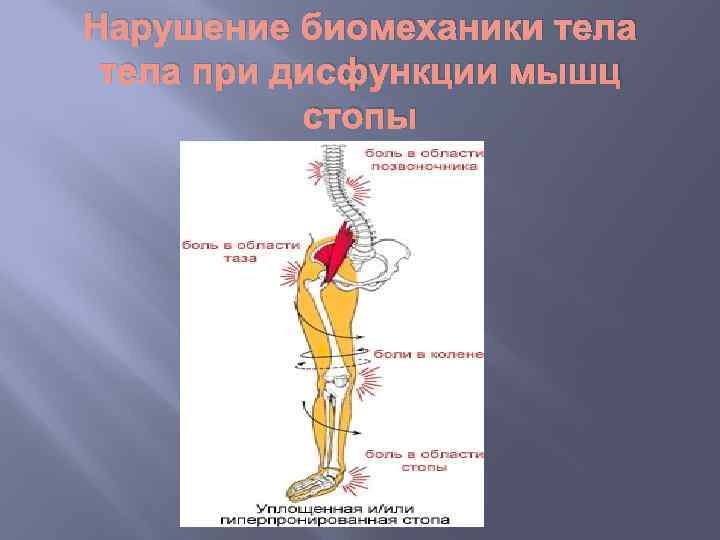 Нарушение биомеханики тела при дисфункции мышц стопы 