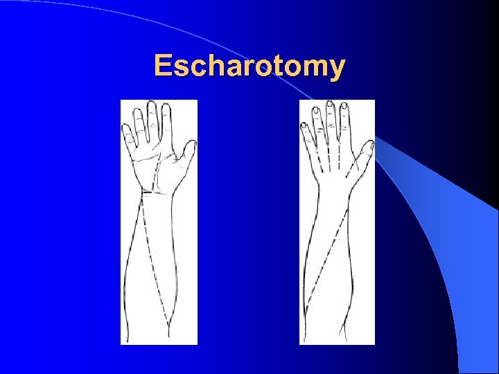 Escharotomy 