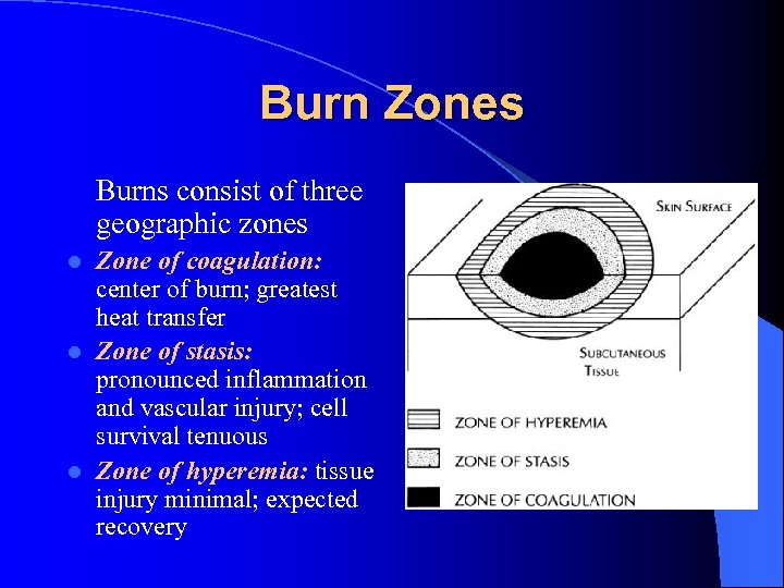 Burn Zones Burns consist of three geographic zones Zone of coagulation: center of burn;