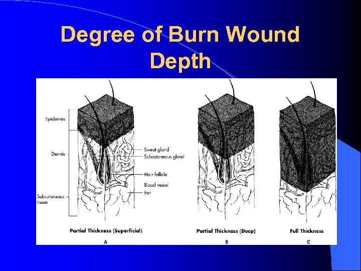 Degree of Burn Wound Depth 