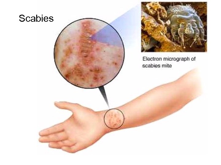 Scabies 