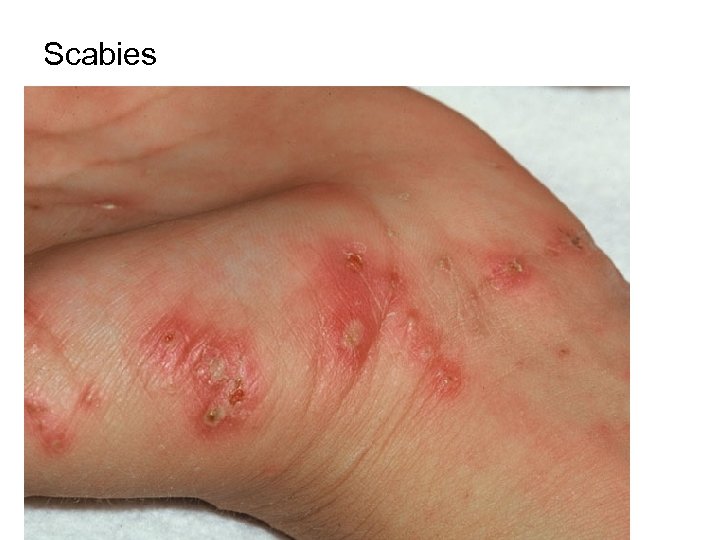 Scabies 