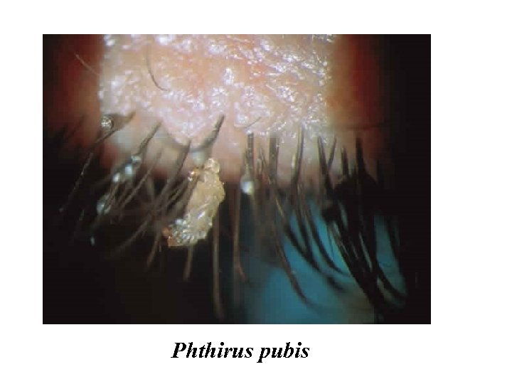 Phthirus pubis 