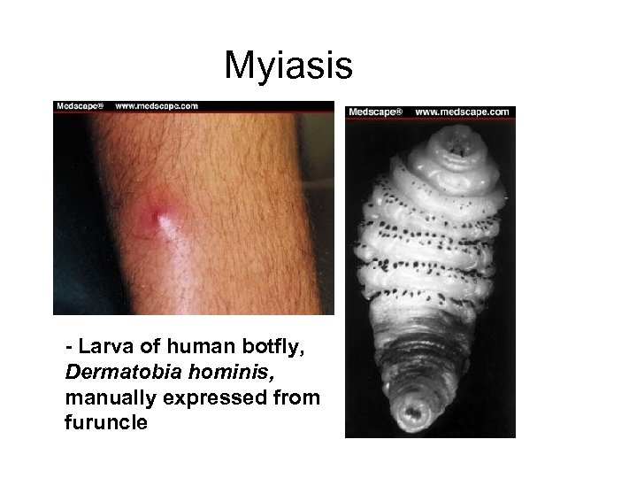 Myiasis - Larva of human botfly, Dermatobia hominis, manually expressed from furuncle 