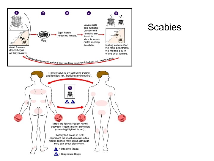 Scabies 