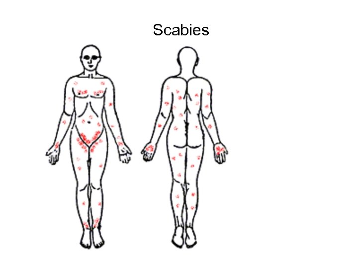 Scabies 