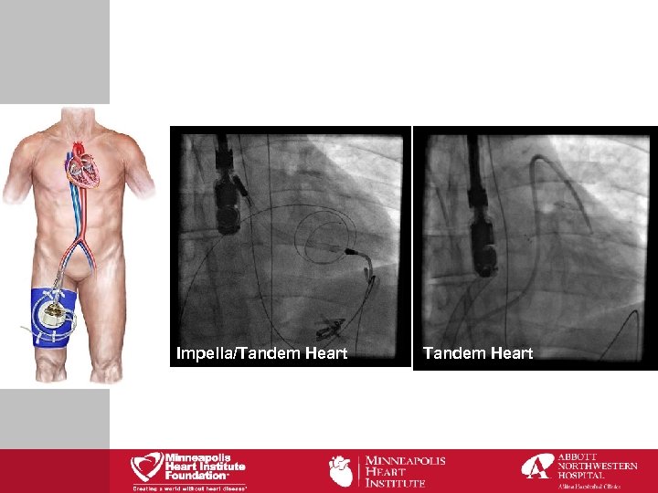 Impella/Tandem Heart 