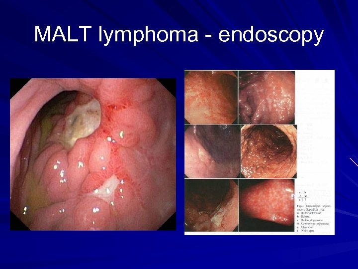 MALT lymphoma - endoscopy 