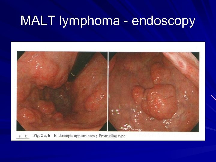 MALT lymphoma - endoscopy 