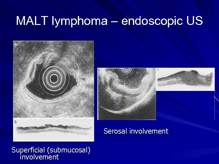 MALT lymphoma – endoscopic US Serosal involvement Superficial (submucosal) involvement 