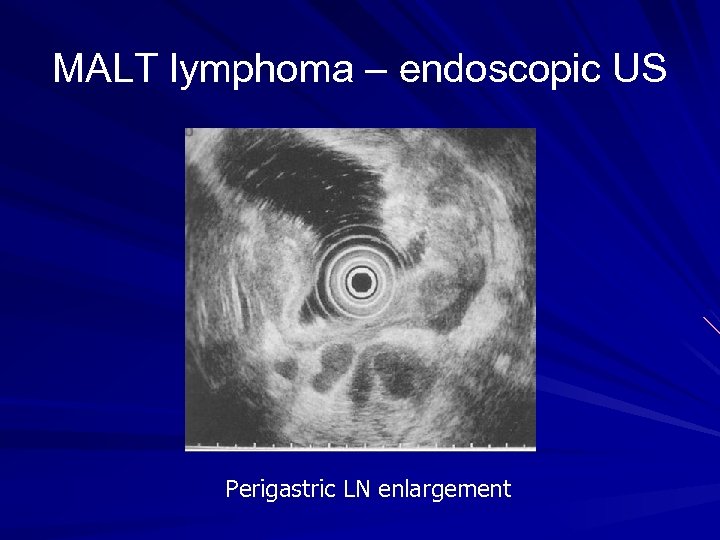 MALT lymphoma – endoscopic US Perigastric LN enlargement 