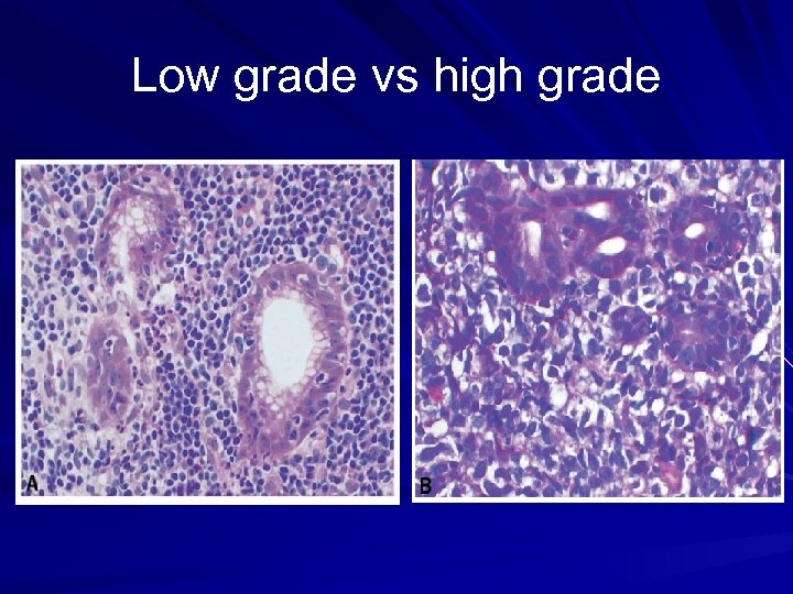 diffuse-large-b-cell-lymphoma-bone-marrow-aspirate-1