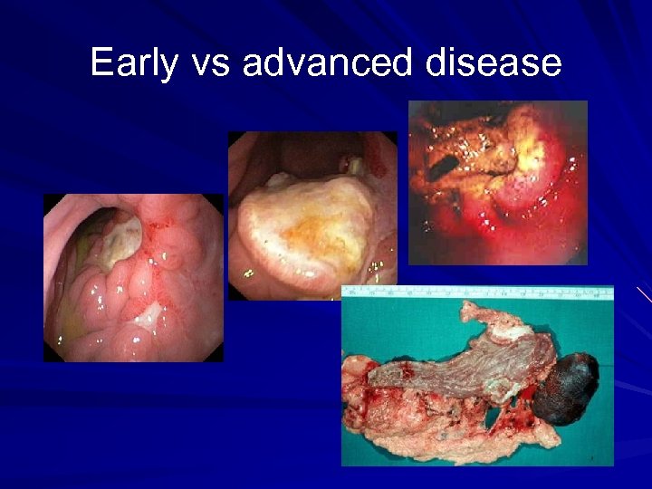 Early vs advanced disease 