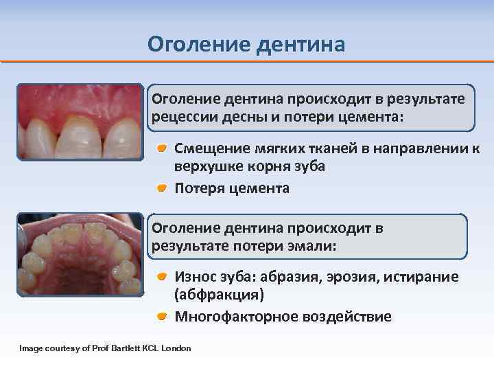 Оголение дентина происходит в результате рецессии десны и потери цемента: Смещение мягких тканей в