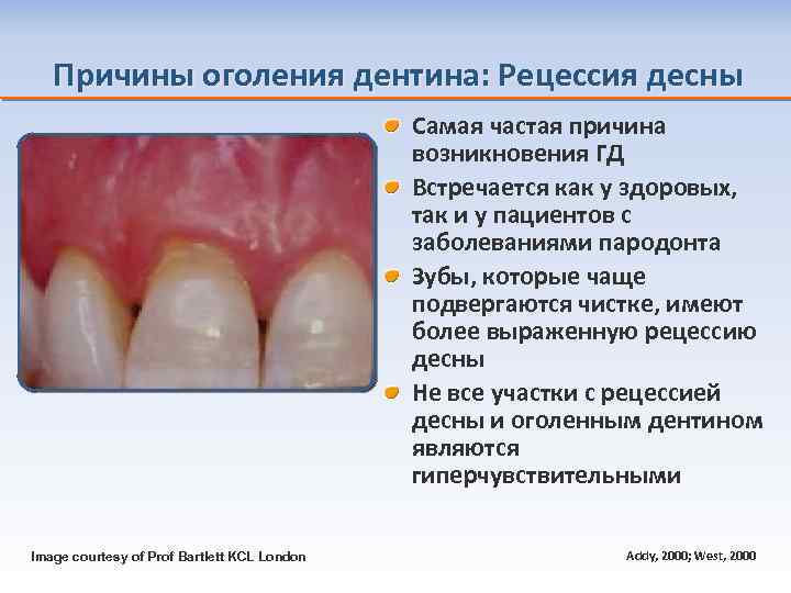 Причины оголения дентина: Рецессия десны Самая частая причина возникновения ГД Встречается как у здоровых,