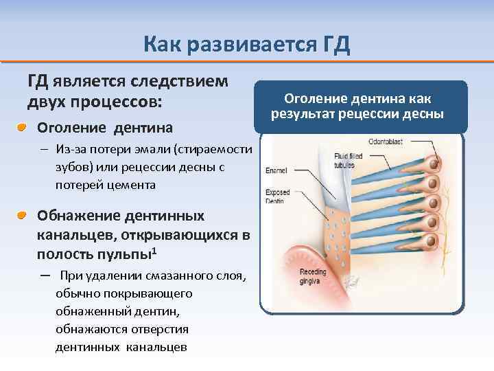 Как развивается ГД ГД является следствием двух процессов: Оголение дентина – Из-за потери эмали