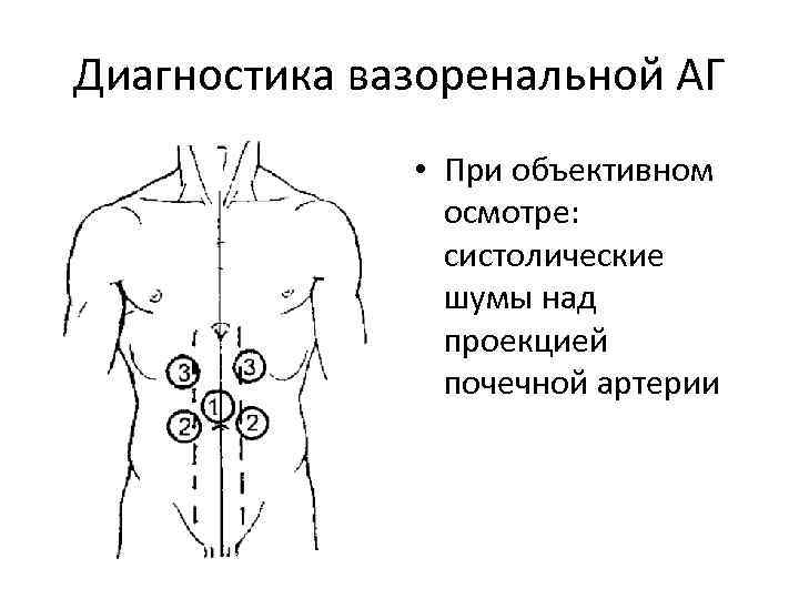 Диагностика вазоренальной АГ • При объективном осмотре: систолические шумы над проекцией почечной артерии 
