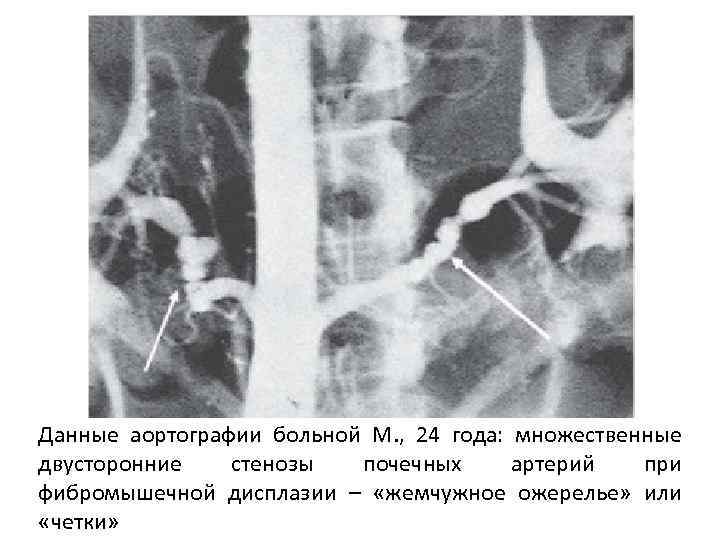 Данные аортографии больной М. , 24 года: множественные двусторонние стенозы почечных артерий при фибромышечной