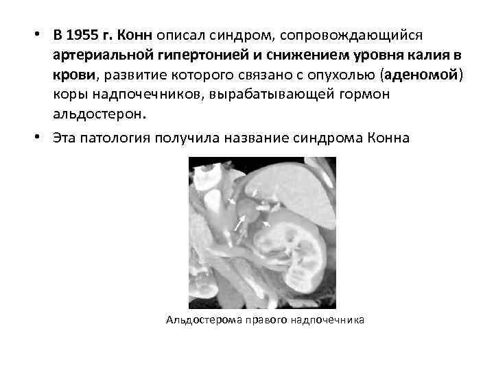  • В 1955 г. Конн описал синдром, сопровождающийся артериальной гипертонией и снижением уровня