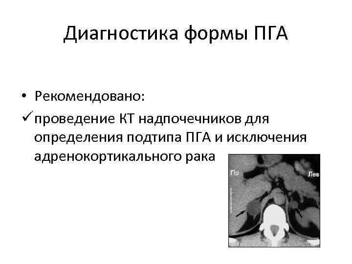Диагностика формы ПГА • Рекомендовано: ü проведение КТ надпочечников для определения подтипа ПГА и