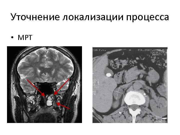 Уточнение локализации процесса • МРТ 