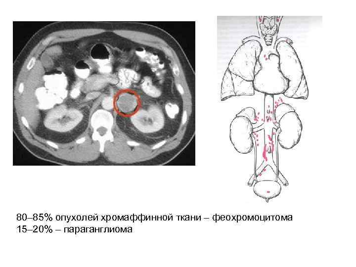 80– 85% опухолей хромаффинной ткани – феохромоцитома 15– 20% – параганглиома 