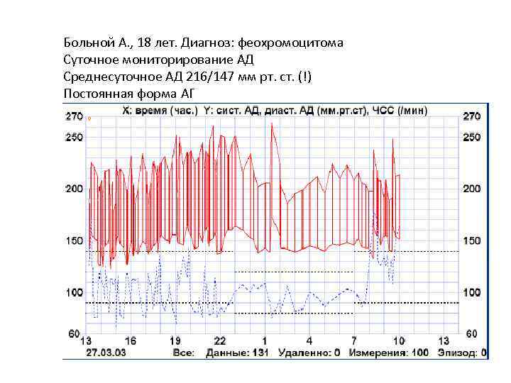 Больной А. , 18 лет. Диагноз: феохромоцитома Суточное мониторирование АД Среднесуточное АД 216/147 мм