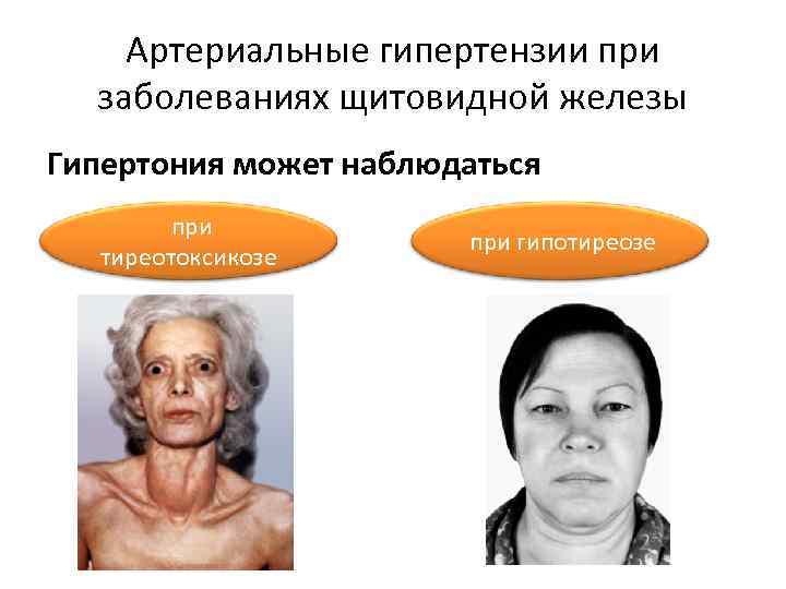 Артериальные гипертензии при заболеваниях щитовидной железы Гипертония может наблюдаться при тиреотоксикозе при гипотиреозе 