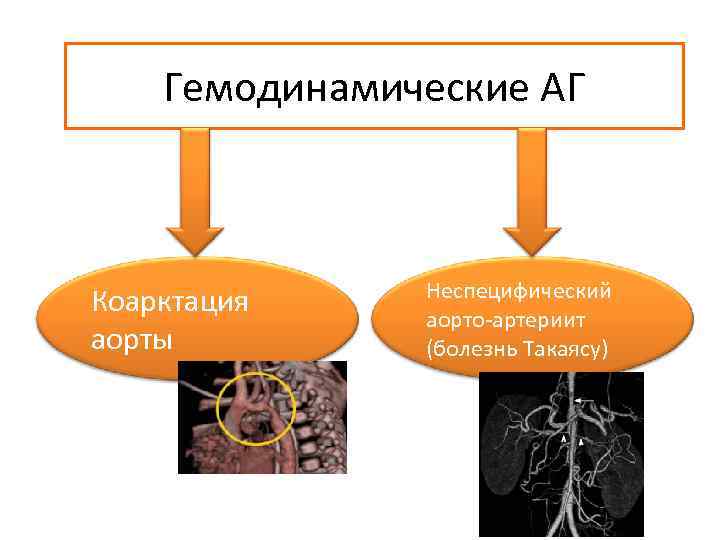 Коарктация аорты гемодинамика схема